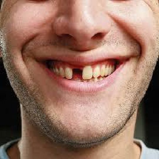 TEMPORARY TOOTH REPLACEMENT, FIX MISSING TOOTH False Tooth Dental Repair